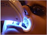 Blanchiment des dents : plus de sécurité, image 1